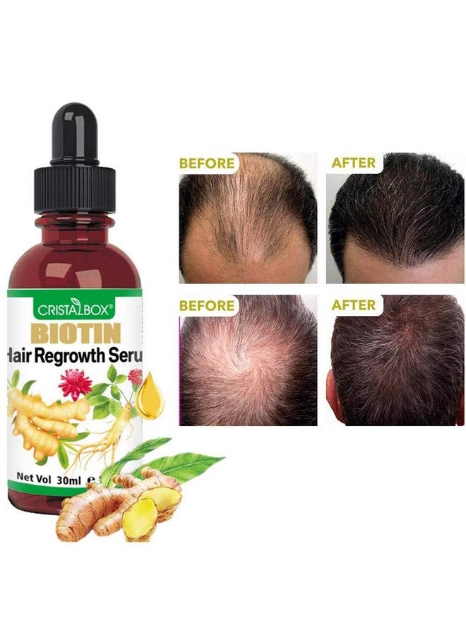 5 Pack Ginger Oil For Hair Growthhair Growth Serumbiotin Hair Growth Oilhair Growth Ginger Serum For Men And Womenhair Growth Treatmenthair Loss Treatmentpromotes Thickergrowth Hair