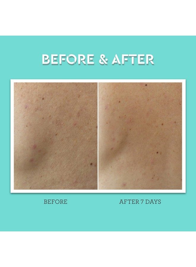 Clear Genius Body Acne Spray 3.5 Fl Oz Maximum Strength 2% Salicylic Acid & Niacinamide Targets Body Acne & Prevents Future Breakouts Post Workout Clean Vegan & Crueltyfree