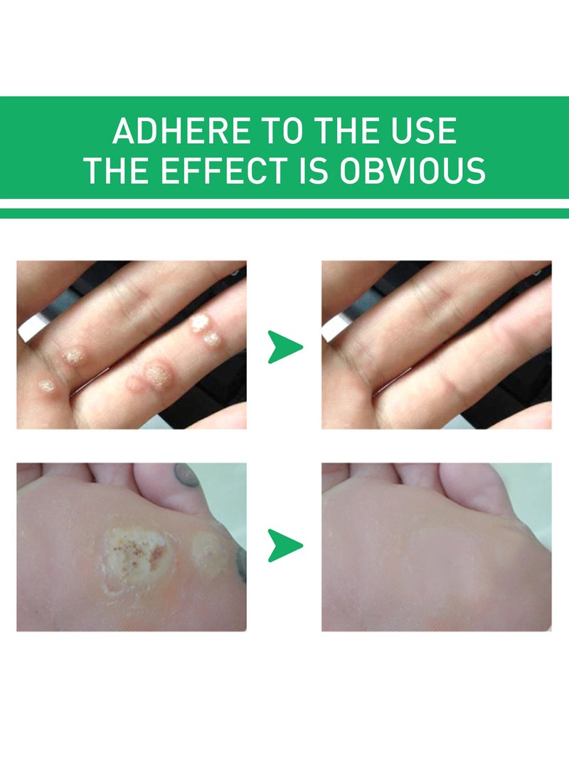 Jaysuing Wart Removing Corns Eye Liquid Smoothes Skin Gentle Foot Care Solution