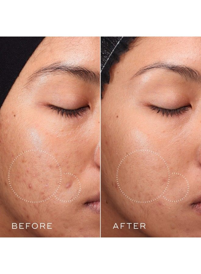 Press And Clear Brightening Daily Facial Exfoliant Exfoliating Bha Toner With Gentlerelease Salicylic Acid Fast Action On Blemishes Supports Skin Natural Moisture Barrier 5 Oz
