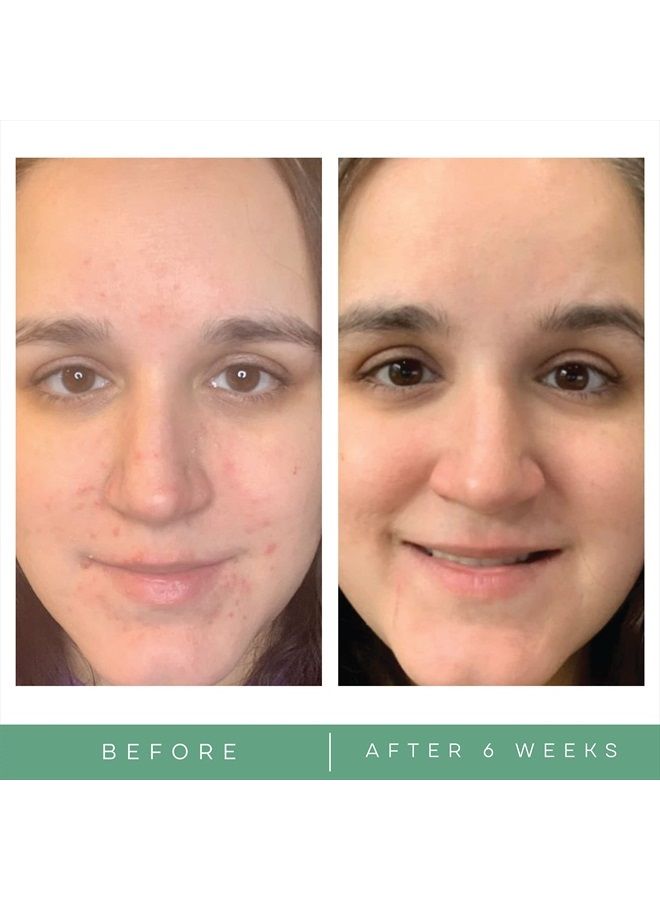 Acne Gly-Sal 5-2 Clarifying Pads – Oil Free Medical Grade Glycolic & Salicylic Acid Pore Cleansing Face Wipes – Exfoliating Breakout and Blackhead Facial Radiance Pads, 60 Ct