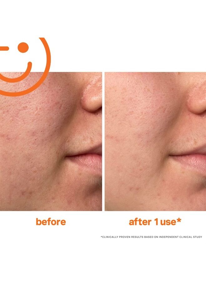 ExfoliKate Intensive Exfoliating Treatment – Salicylic Acid and Lactic Acid Super Facial Scrub Improves Texture and Pores, 2 Fl Oz