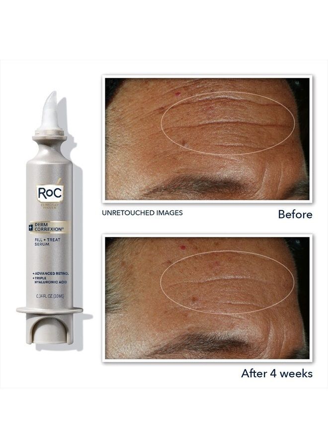 Derm Correxion Fill + Treat Advanced Retinol Serum, Wrinkle Filler Treatment with Hyaluronic Acid for Forehead Wrinkles, Crow's Feet, Eleven Wrinkles, and Laugh Lines, 15ml