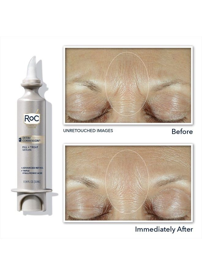 Derm Correxion Fill + Treat Advanced Retinol Serum, Wrinkle Filler Treatment with Hyaluronic Acid for Forehead Wrinkles, Crow's Feet, Eleven Wrinkles, and Laugh Lines, 15ml