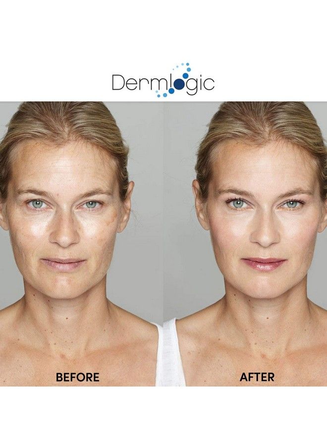 Anti Aging Resurfacing Peel Pads Contains Salicylic Glycolic & Lactic For Face & Body. Includes Hyaluronic & Witch Hazel Green Tea & Aloe Vera. Exfoliates To Correct Dark Spots & Scars.