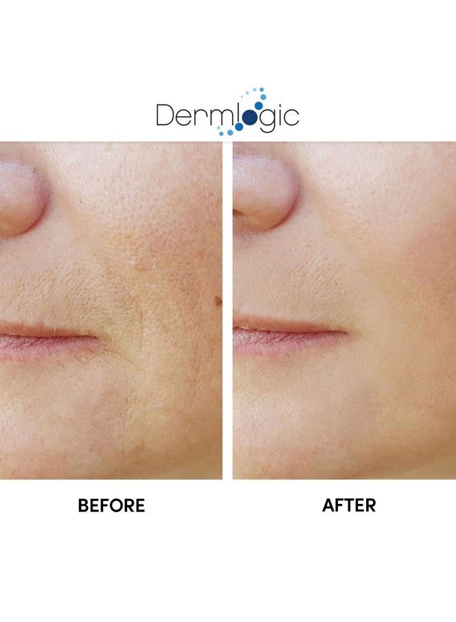 Anti Aging Resurfacing Peel Pads Contains Salicylic Glycolic & Lactic For Face & Body. Includes Hyaluronic & Witch Hazel Green Tea & Aloe Vera. Exfoliates To Correct Dark Spots & Scars.