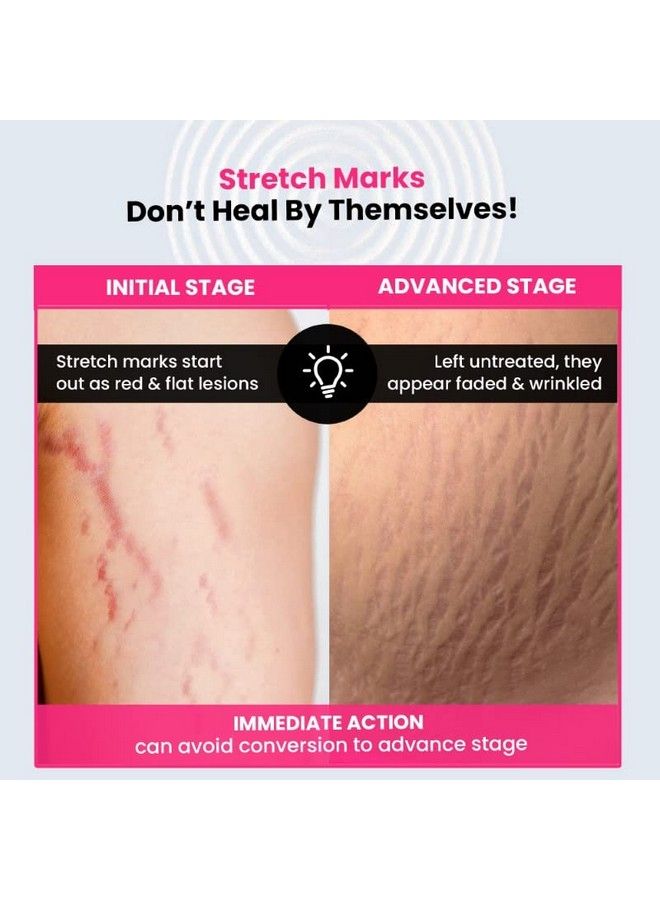 Stretch Marks Expert Serum Cream ; Combats And Improves Appearance Of New And Old Stretchmarks ; Powered By Striover Rosehip Oil And Squalane; Vegan And Crueltyfree ;30Ml