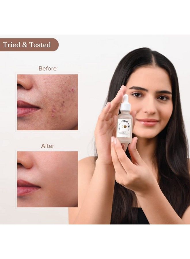 Niacinamide Serum For Improves Skin Texture; Clears Acne Marks And Blemishes Face Serum For Men & Women 30 Ml