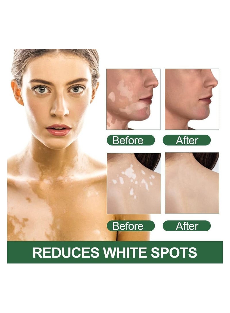 Vitiligo Care Cream Reduces White Spots on Skin, Pigmentation regulating, Improve Skin Pigmentation, 4 Counts Upgraded Vitiligo Creams