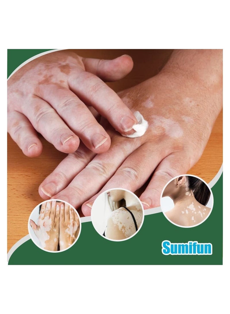 Vitiligo Care Cream Reduces White Spots on Skin, Pigmentation regulating, Improve Skin Pigmentation, 4 Counts Upgraded Vitiligo Creams