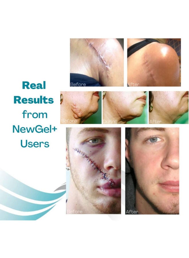 Silicon Gel Dots Clear for Scar Removal