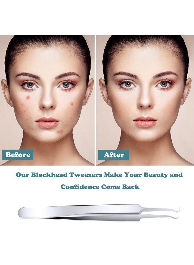 6 Pack Acne Pimple Blackhead Remover Tweezers Stainless Steel Acne Tweezers Curved Pimple Tweezers Extractors Tool For Blackhead Blemish Removalsilver Color