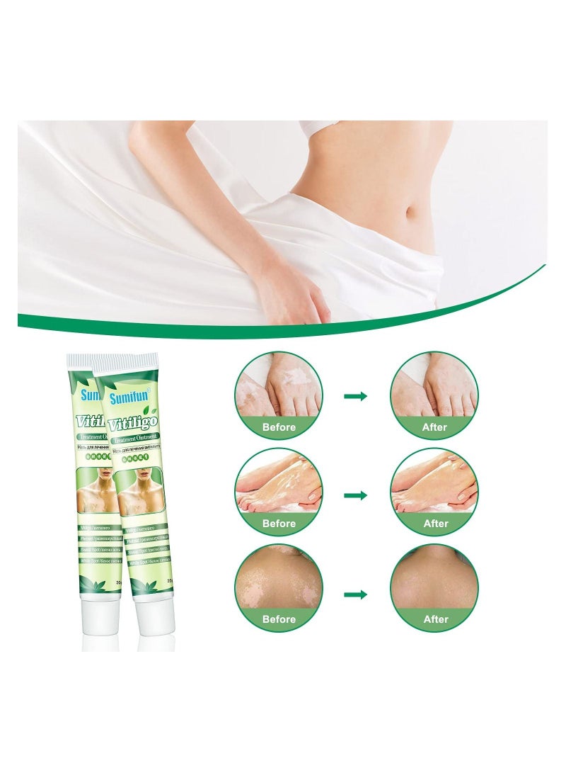 Vitiligo Treatment Ointment Cream for Skin Vitiligo, Psoriasis, Leukoplakia - Reduces White Spots on Skin and Improve Skin Pigmentation 6 Counts