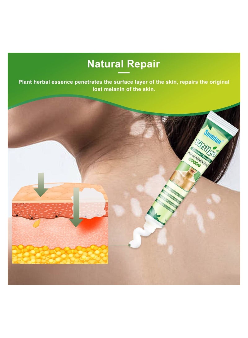 Vitiligo Treatment Ointment Cream for Skin Vitiligo, Psoriasis, Leukoplakia - Reduces White Spots on Skin and Improve Skin Pigmentation 6 Counts