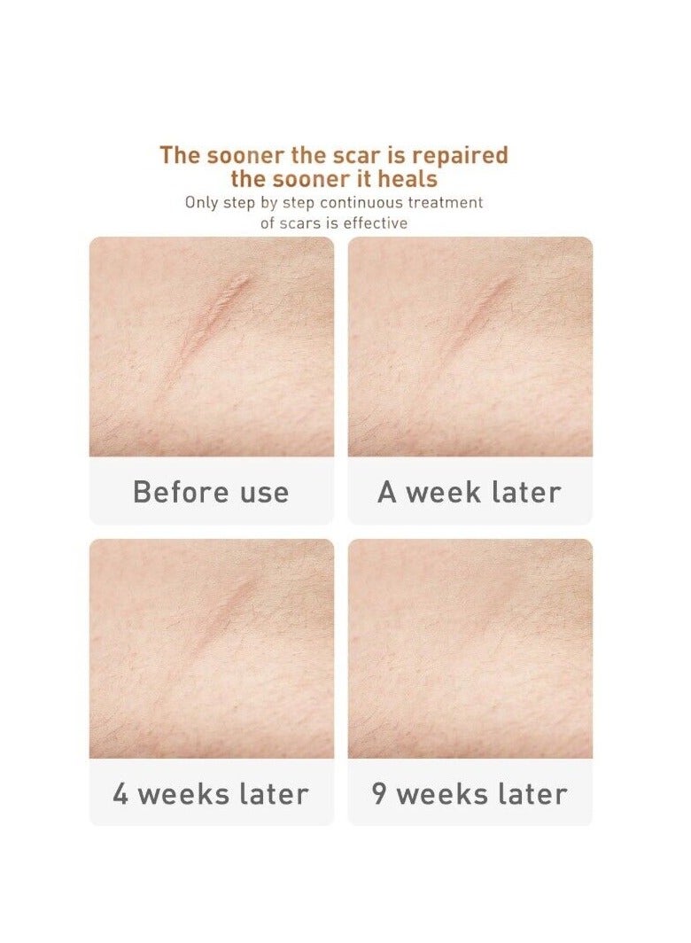 Lanbena TCM Scar and Acne Mark Removal Gel Ointment 30G 2 Pack