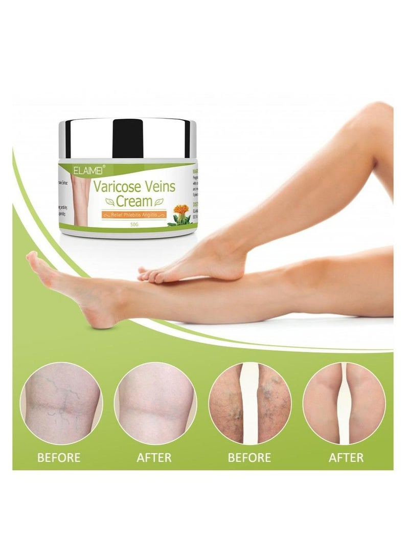 Varicose Vein Cream (50g) Eliminate And Relief The Appearance Of Spider Veins & Phlebitis Angiitis For Foot Hands Legs Toes Body & Arms For Men And Women