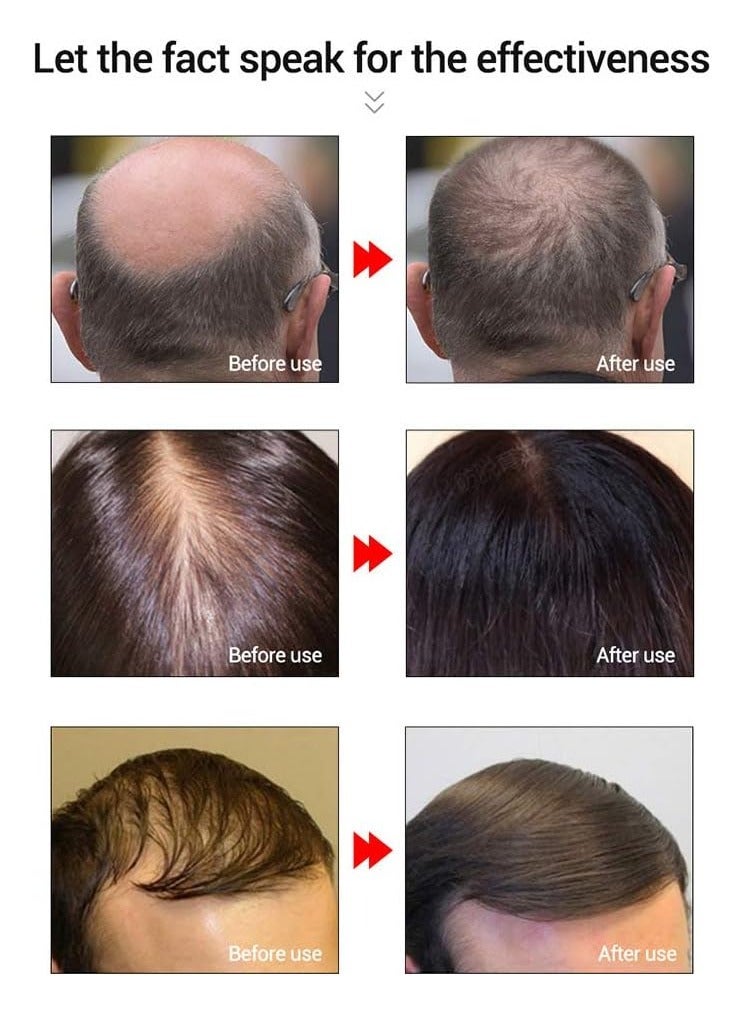 Hair Growth Essence Fast Powerful Hair Care Essential Oil Treatment Preventing Hair Loss 20ml 2 Pack