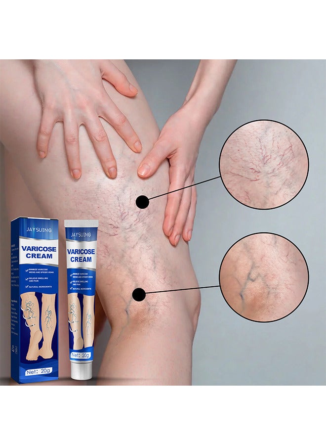 Varicose Veins Cream, Relief Phlebitis Angiitis 100% Natural Ingredients Added Eliminate The Appearance Of Varicose Veins - Vein Inflammation Treatment For Men And Women 20G