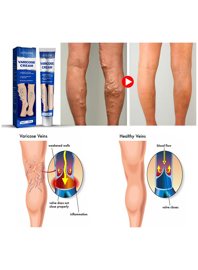 Varicose Veins Cream, Relief Phlebitis Angiitis 100% Natural Ingredients Added Eliminate The Appearance Of Varicose Veins - Vein Inflammation Treatment For Men And Women 20G