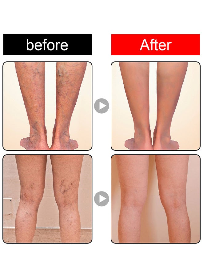 Varicose Veins Cream, Relief Phlebitis Angiitis 100% Natural Ingredients Added Eliminate The Appearance Of Varicose Veins - Vein Inflammation Treatment For Men And Women 20G
