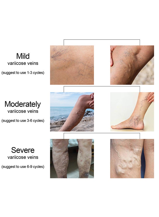 Varicose Veins Cream, Relief Phlebitis Angiitis 100% Natural Ingredients Added Eliminate The Appearance Of Varicose Veins - Vein Inflammation Treatment For Men And Women 20G