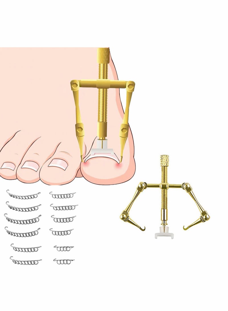 Ingrown Toenail Treatment Kit with 12 Toenail Braces, Pure Copper Ingrown Toenail Lifter, Steel Foot Care Tool for Paronychia