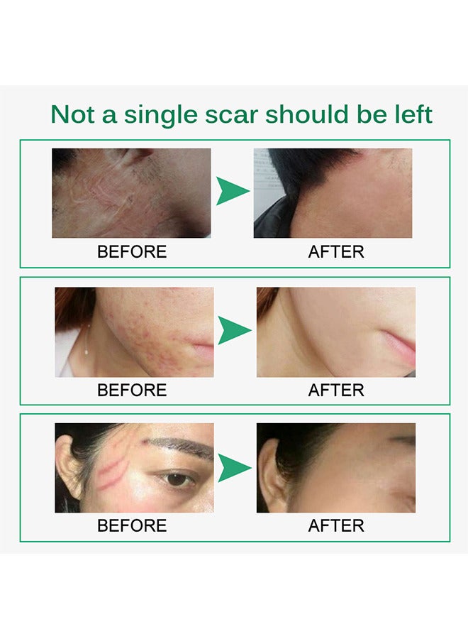 Scar Removal Cream, Advanced Scar Gel For Surgical And Acne Scars, Cuts, Burns, Helps With Old And New Scars, Natural Scar Treatment For Face And Body 50ML