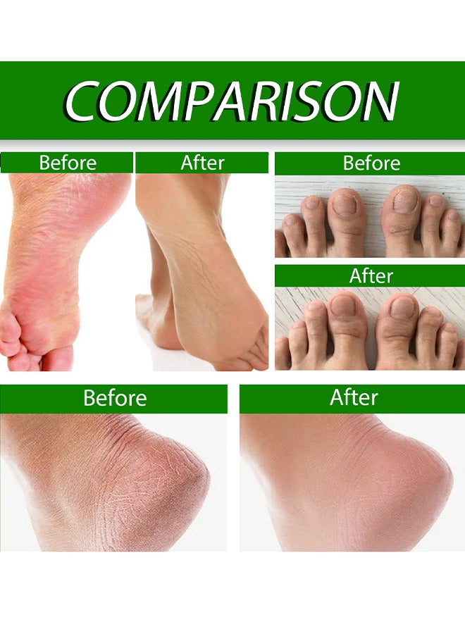 Foot Care Cream Allantoin 40% Cream For Cracked, Rough Thick And Dry Skin Soothes And Softens Feet, Elbows And Knees Hydrating And Moisturizing Foot Care Cream