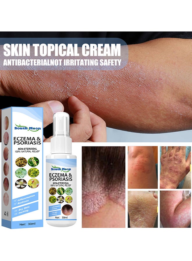 Natural Chinese Herbal Eczema And Psoriasis Spray, Dermatitis And Eczema Pruritus Psoriasis Spray, Say Goodbye To Scaly Skin, Eczema Relief Spray, Stops Burning And Itching 30ML