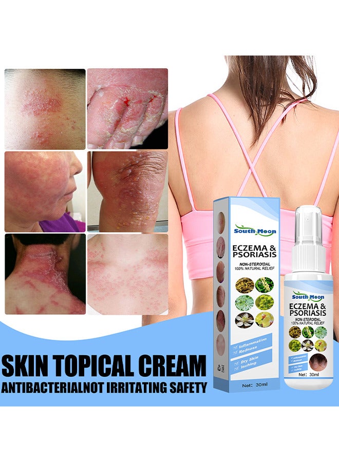 Natural Chinese Herbal Eczema And Psoriasis Spray, Dermatitis And Eczema Pruritus Psoriasis Spray, Say Goodbye To Scaly Skin, Eczema Relief Spray, Stops Burning And Itching 30ML
