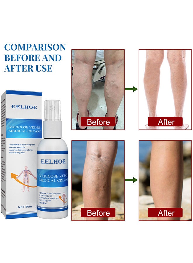 Varicose Veins Medical Cream, Eliminate And Spider Veins Spray, Varicose Veins Relief, Improve Blood Circulation, Soothes Tired Legs, Antiedema, Improve Blood Circulatio Quickly Soothing Swelling 30ML