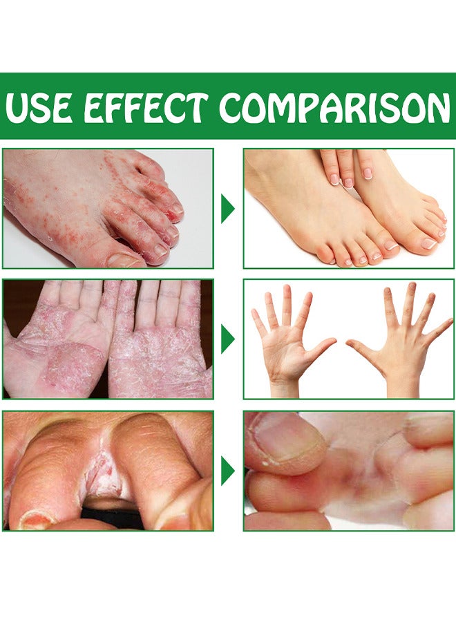 Hand Ringworm BeriBeri Fungus Spray, Anti-Fungi Treatment For Feet Itchy, Sweating, Peeling And Blisters, Natural Ingredients Foot Fungi Spray For Tinea Pedis, Inflamed, Feet Smelly 30ML