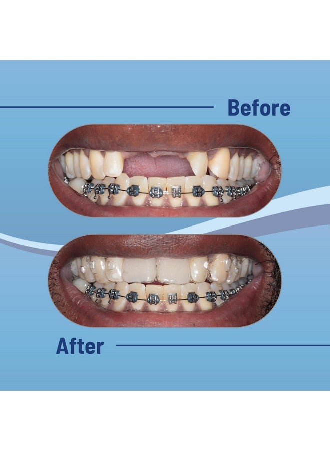 Aligner Pontics Temporary Tooth Replacement For Aligner Tray And Retainerfill Space Of Missing Teeth With Fake Teeth (16 Count)