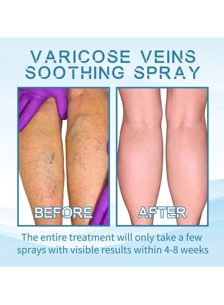 Varicose Veins Treatment Spray, 30ml Vasculitis Phlebitis Relief Cream, Healing Varicose Vein Spray For Legs, Improve Blood Circulation, Soothes Tired Legs, (30ml)
