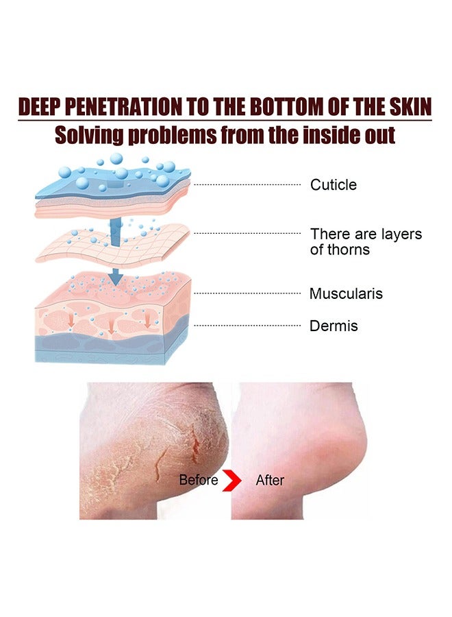 Urea Cream 42% And Salicylic Acid 2%, Foot Cream For Dry Cracked Heels Knees Elbows Hands Repair Treatment, Foot Moisturizer Corn Callus Dead Skin Remover Toenail Softener For Foot Care 100g