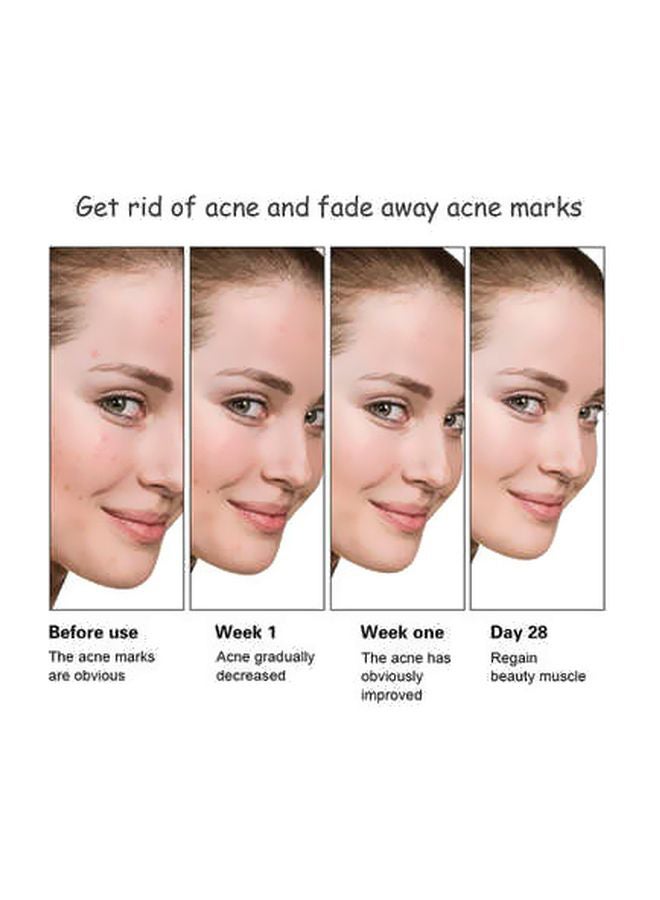 Anti Acne Whitening Facial Serum 30ml