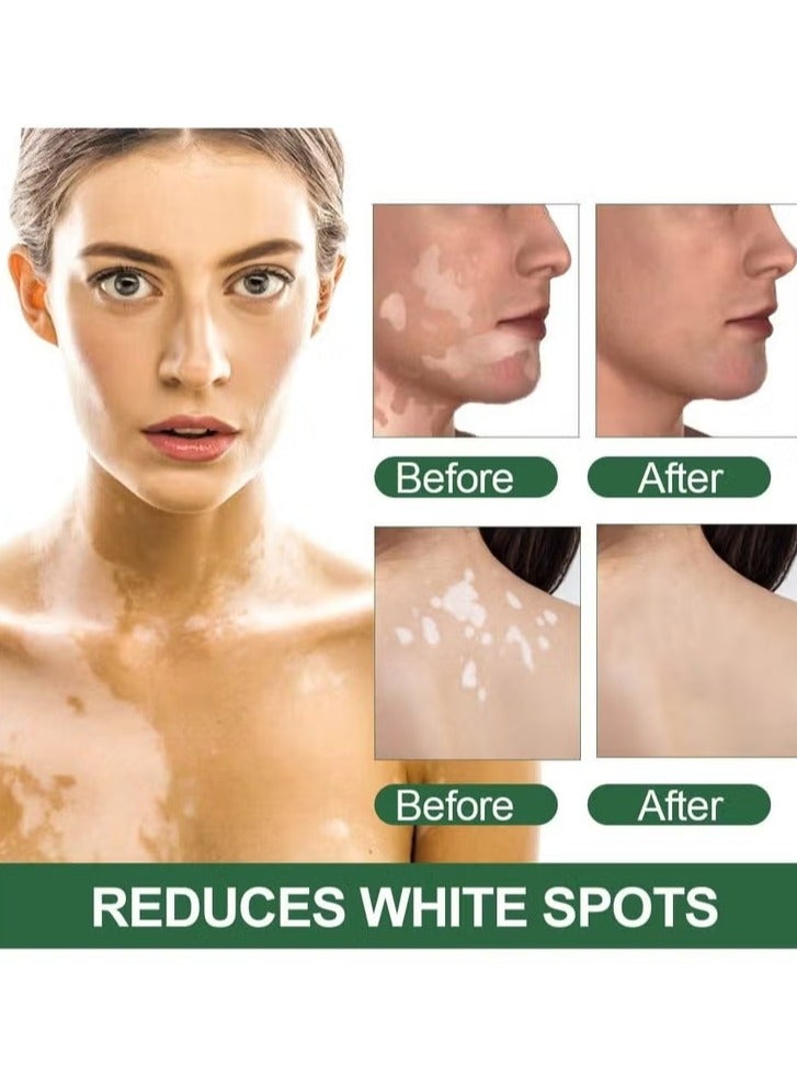 Vitiligo Care Cream, Natural Herbal Formula Anti Vitiligo Cream, Moisturizing White Spots Remover Cream, Fast Absorption Effective Vitiligo Care Cream For Skin Vitiligo, Psoriasis, Leukoplakia