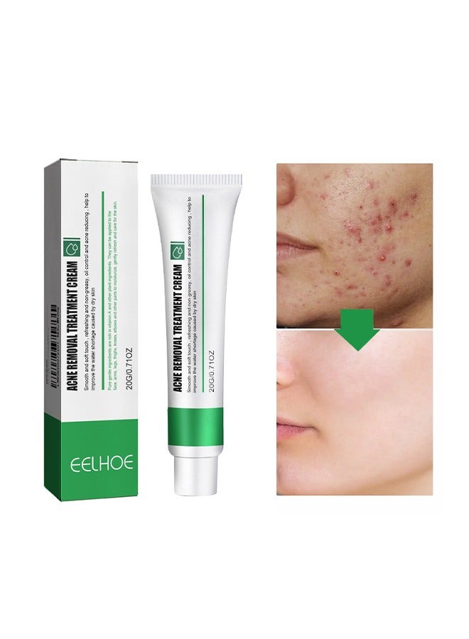 Acne Removal Treatment Cream, Acne Removal Acne Pimple Repair Cream, Acne Spot Treatment for Face & Acne Dots, Natural Cystic Acne Treatment Suitable for Oily And Acne Prone Skin, Oil Control Acne Cre