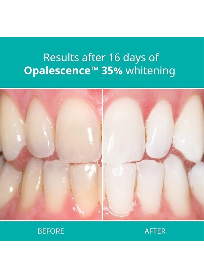 35% Gel Syringes Teeth Whitening - Refill Kit (6 Pack / 12 Syringes), Made by Ultradent, Carbamide Peroxide in Mint Flavor. Tooth Whitening 5197-12