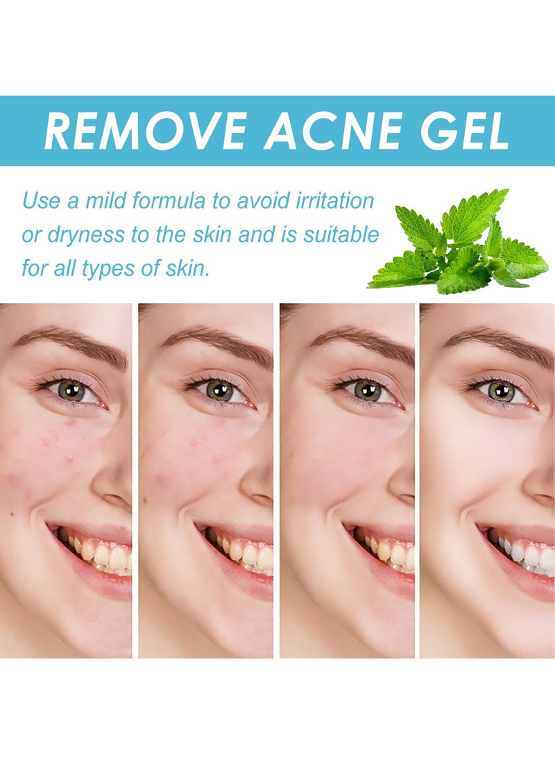 OUHOE Repair Facial Closed Acne, Fade Acne Marks and Blackheads 20g