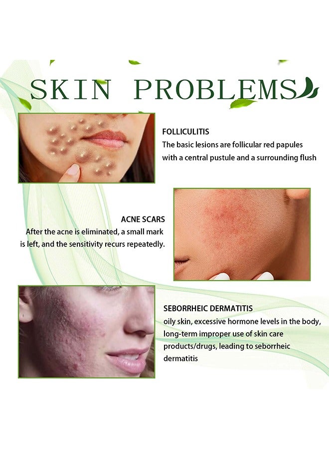 Face cream BHA & VITAMIN A ,Acne Treatment Face Cream, Acne Spot Treatment for Face & Acne Dots, Natural Cystic Acne Treatment, For All Skin Types, Premium Acne Scar Cream & Pimple Remover - 30g