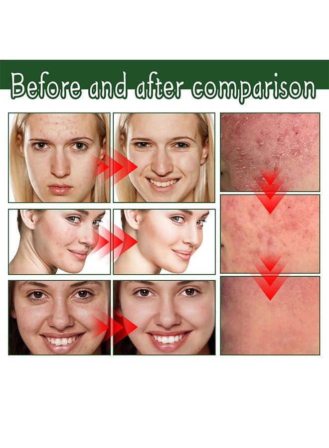 Face cream BHA & VITAMIN A ,Acne Treatment Face Cream, Acne Spot Treatment for Face & Acne Dots, Natural Cystic Acne Treatment, For All Skin Types, Premium Acne Scar Cream & Pimple Remover - 30g