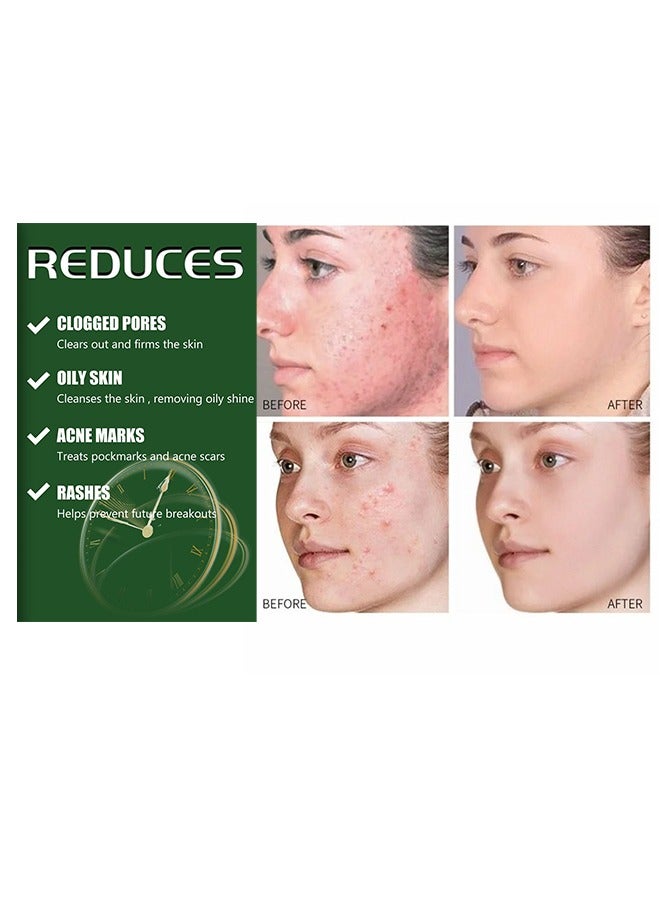 Face cream BHA & VITAMIN A ,Acne Treatment Face Cream, Acne Spot Treatment for Face & Acne Dots, Natural Cystic Acne Treatment, For All Skin Types, Premium Acne Scar Cream & Pimple Remover - 30g