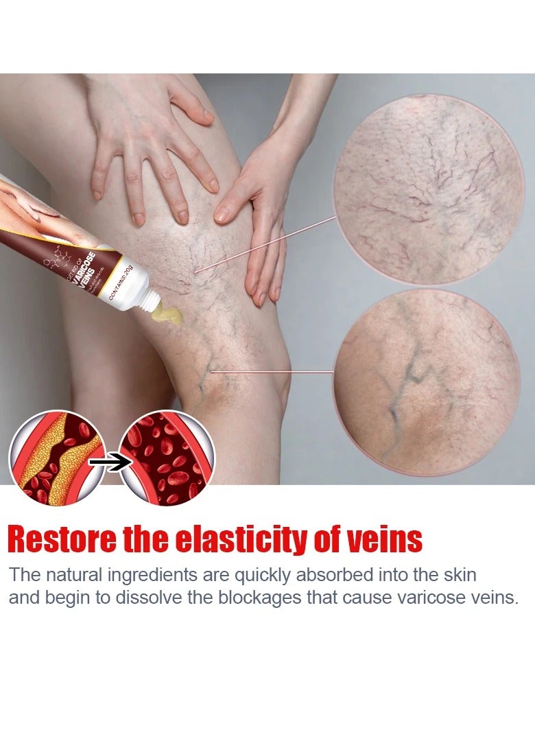 Varicose Veins Remove Cream, Blood Circulation Vein Care Leg Cream, Vasculitis Phlebitis Foot Care Ointment, Pain Relief Therapy Firming Vein Lotion For Treatment Of Varicose Veins