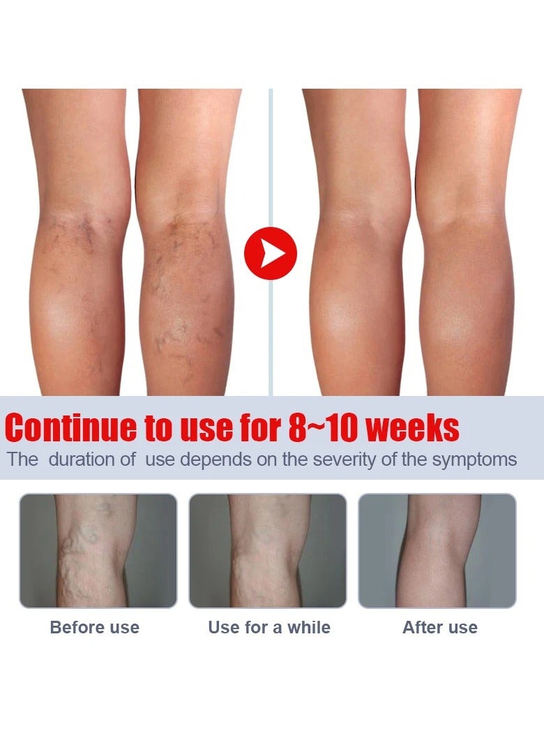 Varicose Veins Remove Cream, Blood Circulation Vein Care Leg Cream, Vasculitis Phlebitis Foot Care Ointment, Pain Relief Therapy Firming Vein Lotion For Treatment Of Varicose Veins
