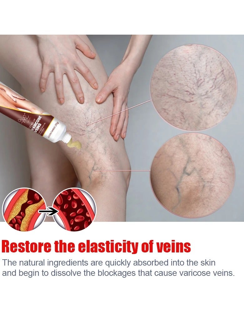 Varicose Veins Remove Cream, Blood Circulation Vein Care Leg Cream, Vasculitis Phlebitis Foot Care Ointment, Pain Relief Therapy Firming Vein Lotion For Treatment Of Varicose Veins