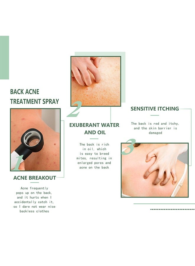 Back Acne Treatment Spray, 2% Salicylic Acid Spray, Body Acne Treatment with Herbal Formula, Body Acne Spray, Tea Tree Oil Spray, Acne Treatment For Teens, Back Acne 120ml