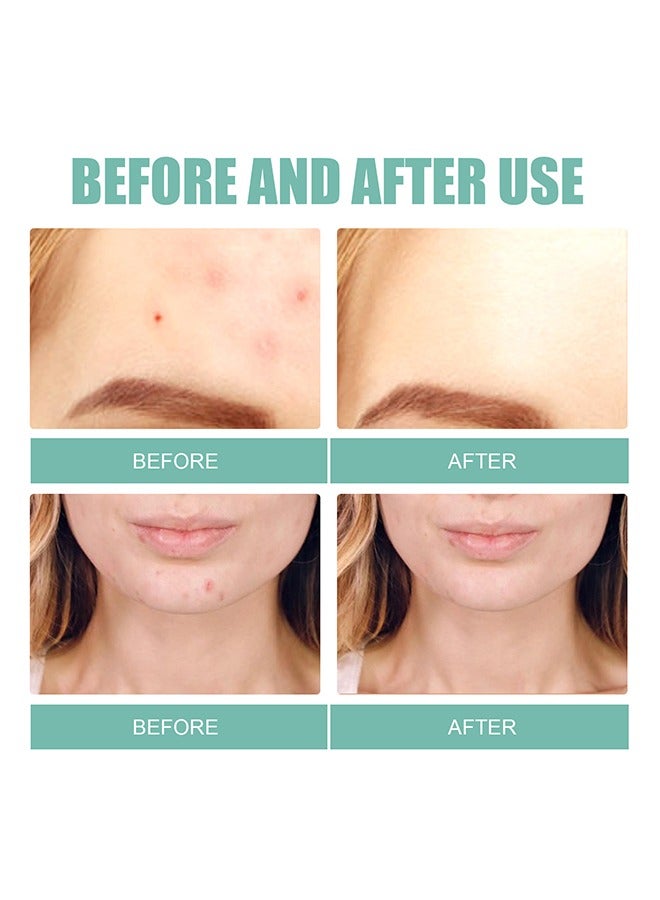 Pimple Patches Acne Patches, 5 Sizes 132 Patches Pimple Patches For Face, Chin Or Body, Acne Treatment with Tea Tree And Salicylic Acid, Hydrocolloid Bandages For Acne Skin