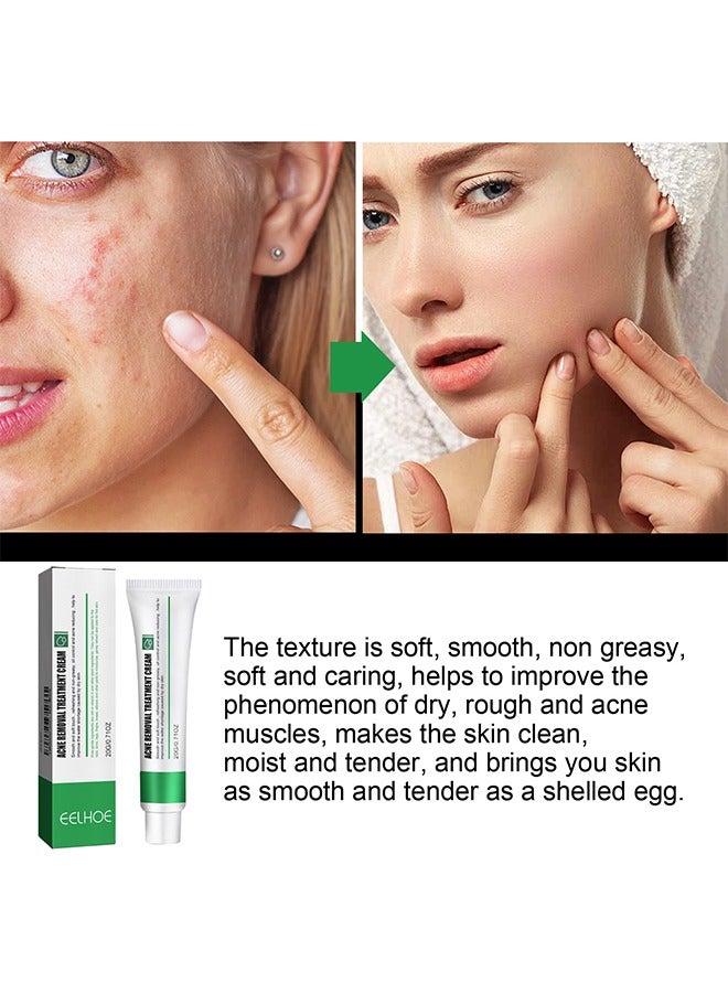 Acne Removal Treatment Cream, Oil Control Acne Removal Acne Pimple Repair Cream, Acne Spot Treatment for Face & Acne Dots, Natural Cystic Acne Treatment Suitable for Oily And Acne Prone Skin 20g