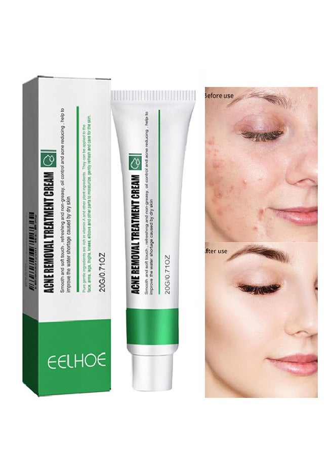 Acne Removal Treatment Cream, Oil Control Acne Removal Acne Pimple Repair Cream, Acne Spot Treatment for Face & Acne Dots, Natural Cystic Acne Treatment Suitable for Oily And Acne Prone Skin 20g